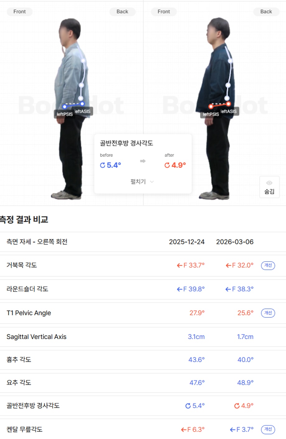 골반 전후방 경사 수치가 안좋아진 경우